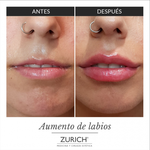 Aumento de labios